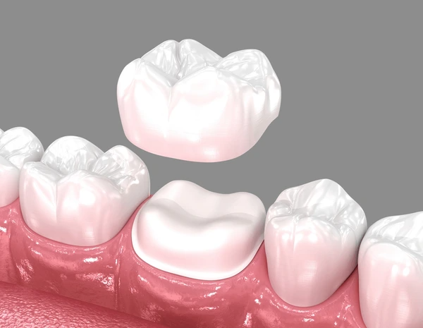 dental crowns near you