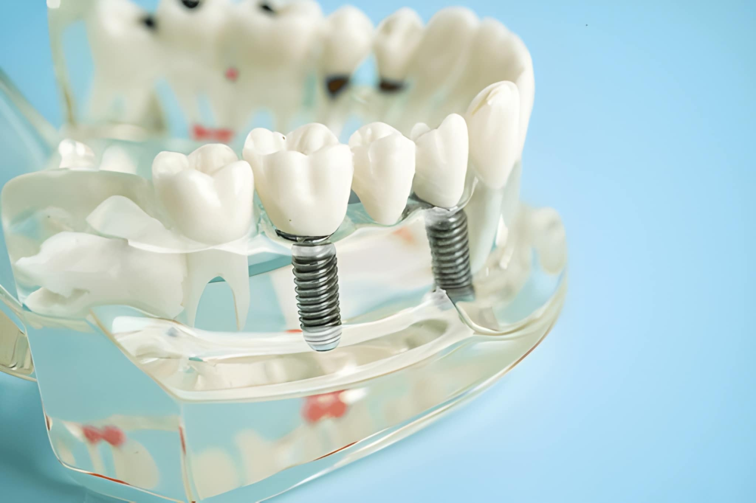 dental implants in edmonton