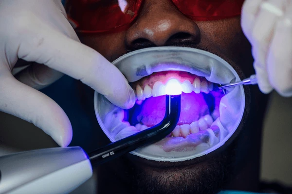 teeth whitening in edmonton