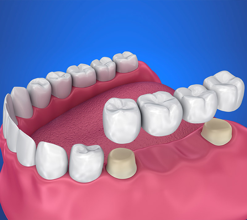 dental bridges in edmonton