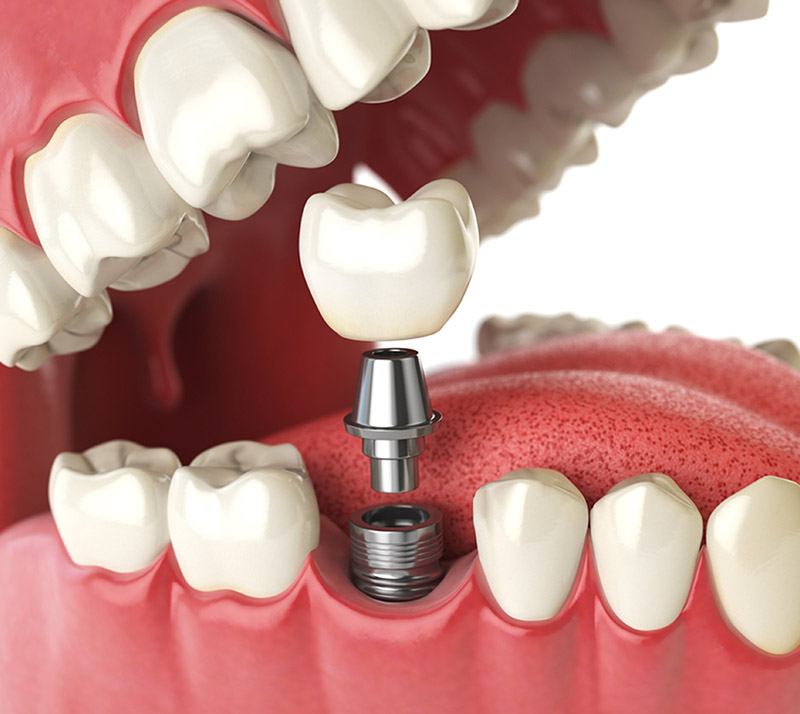 dental implants in edmonton