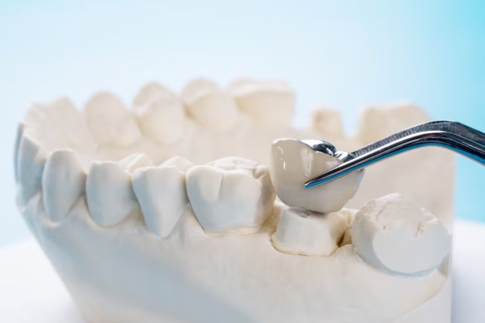 beyond-aesthetics-understanding-the-functional-benefits-of-dental-crowns-in-restorative-dentistry
