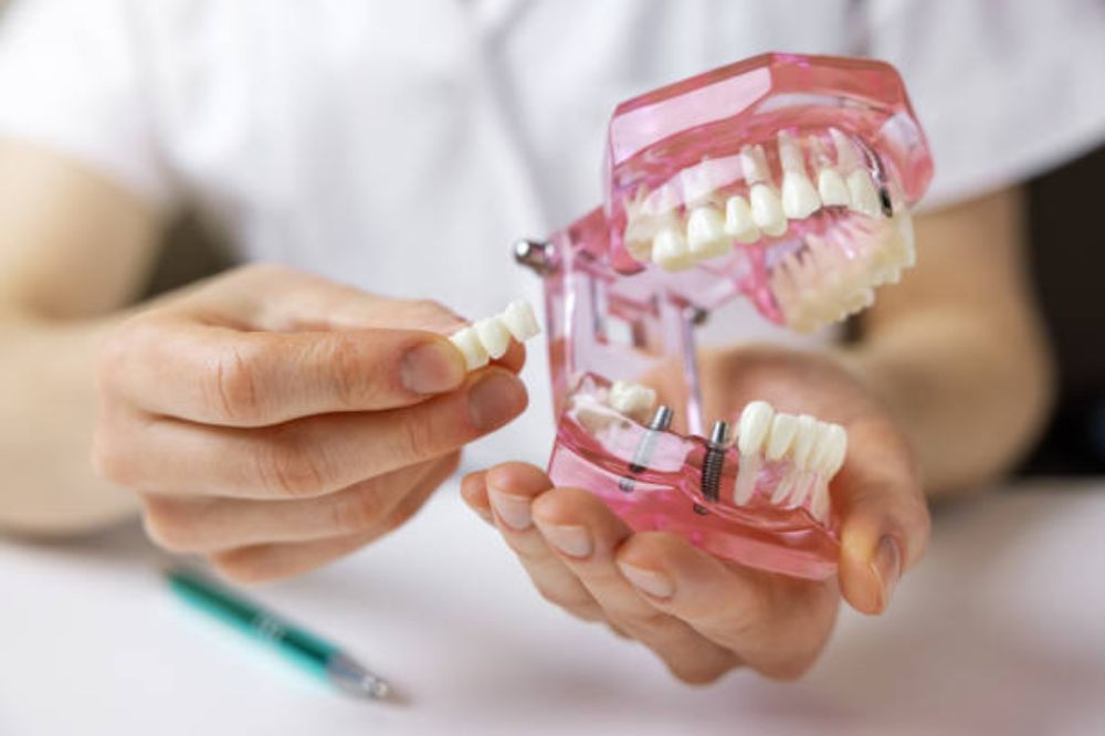 how-often-should-i-replace-my-dental-bridge